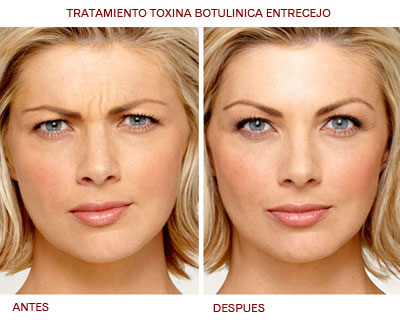 Hiperhidrosis