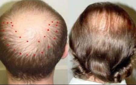 Mesoterapia Capilar