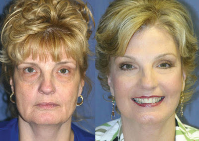 Hilos de Sustentacion Facial