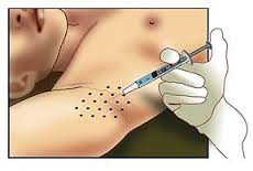 Hiperhidrosis